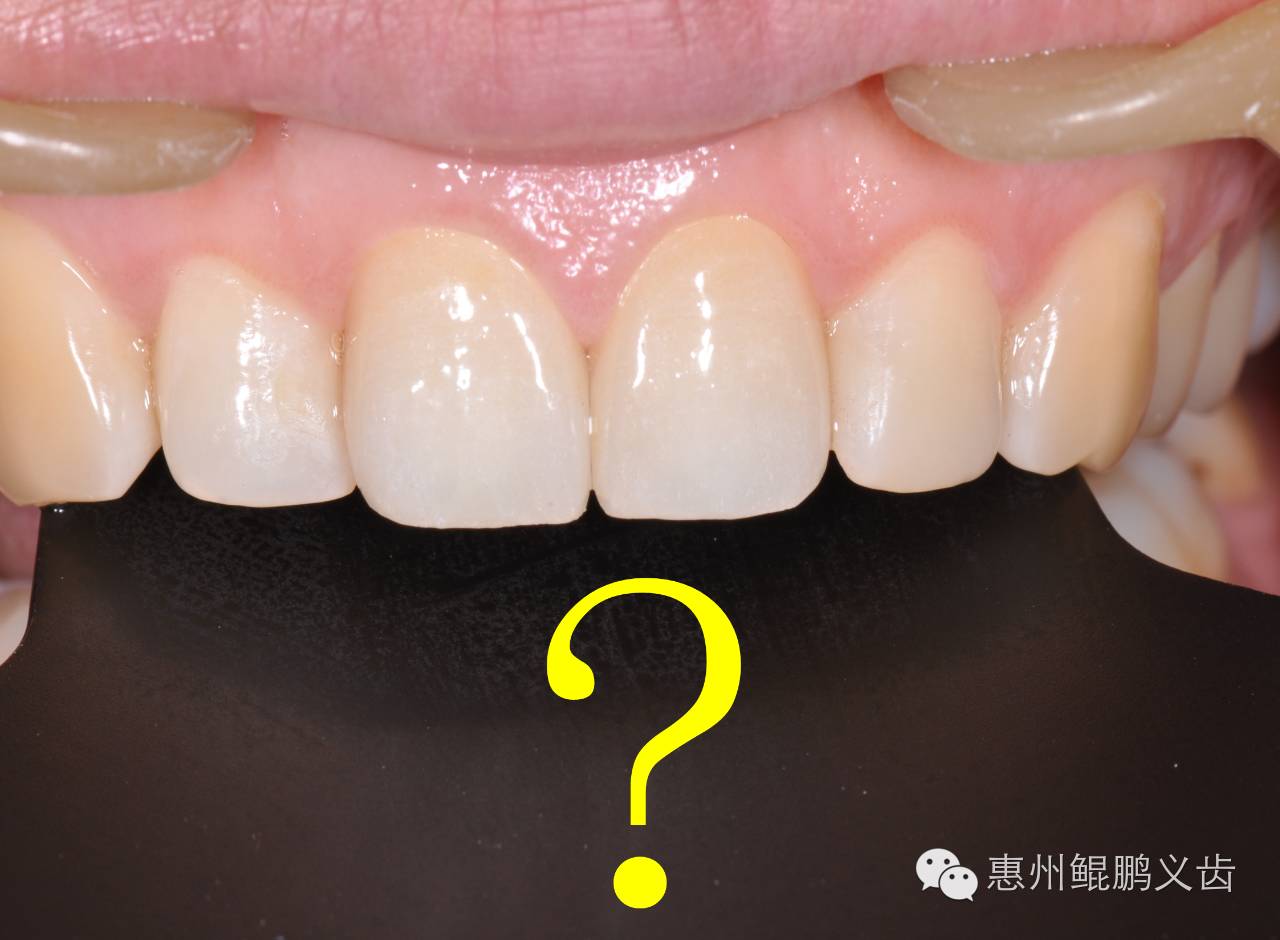 以假亂真—貝特福無(wú)飾瓷美學(xué)修復(fù)病例鑒賞 